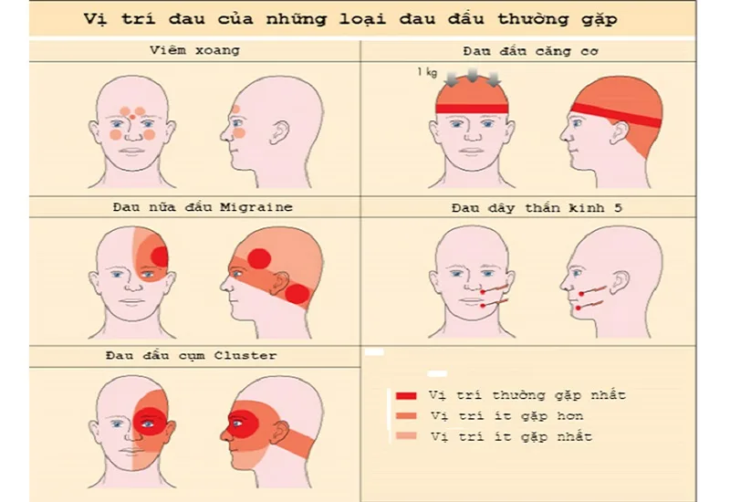 các loại đau đầu
