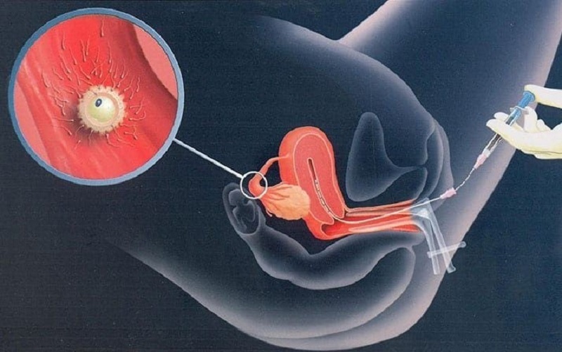 Kỹ thuật bơm tinh trùng vào buồng tử cung (IUI)