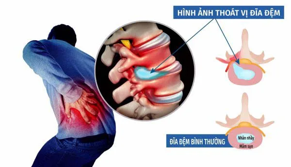 thoat-vi-dia-dem-gay-dau-lung