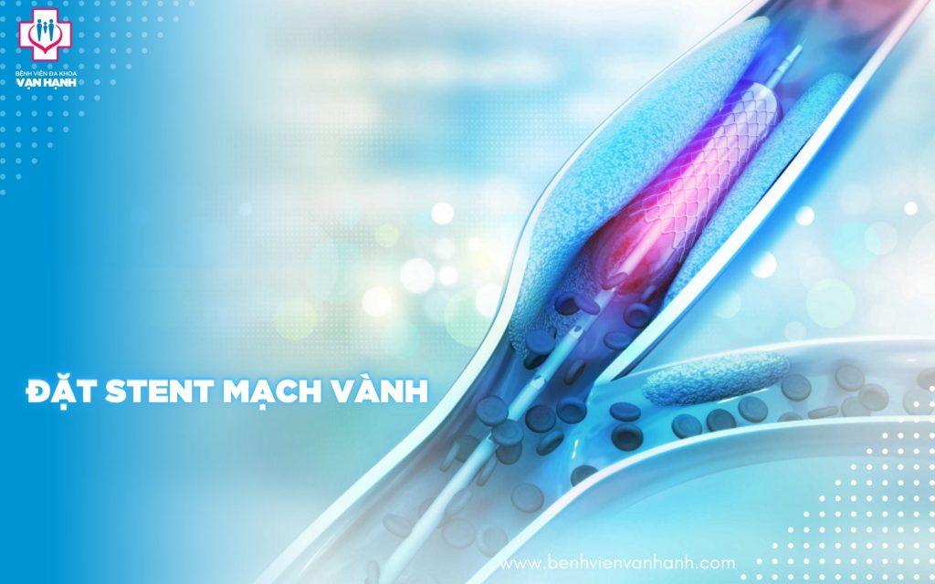 khi-nao-can-dat-stent-mach-vanh