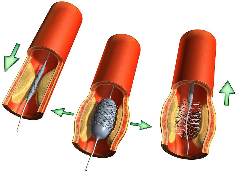đặt stent hẹp mạch vành
