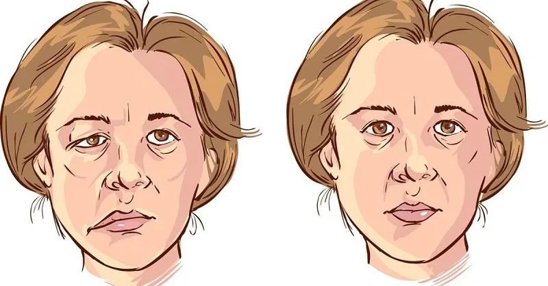 cứu ngải điều trị liệt mặt