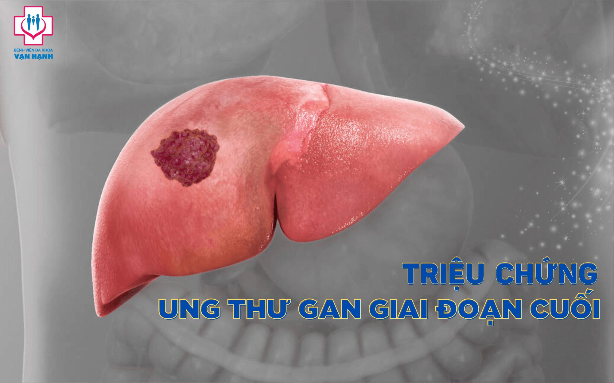 U gan giai đoạn cuối: Triệu chứng, điều trị và cách chăm sóc hiệu quả