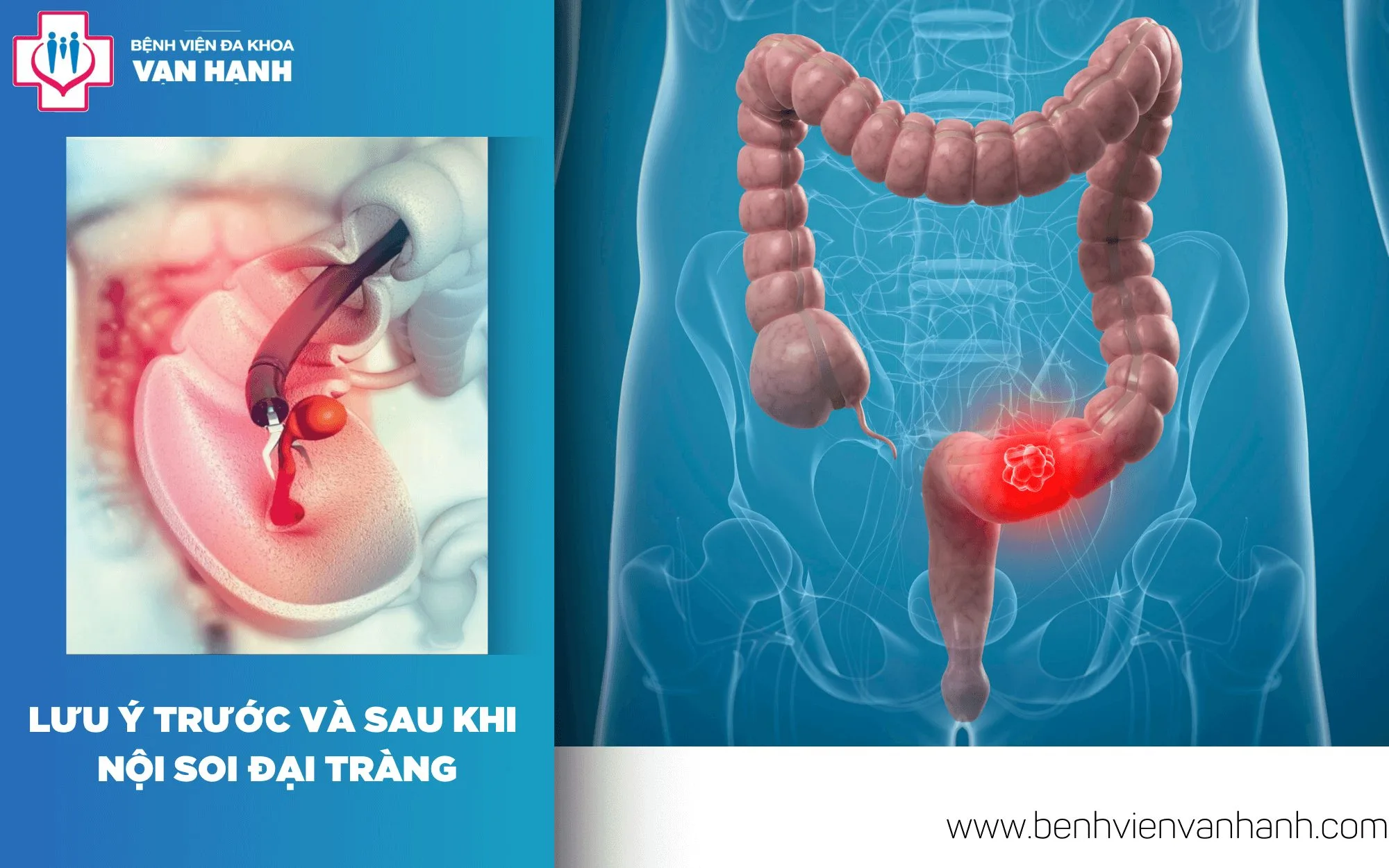 lưu ý trước và sau nội soi đại tràng