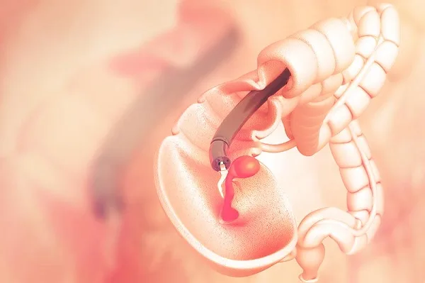 nội soi đại tràng cắt polyp