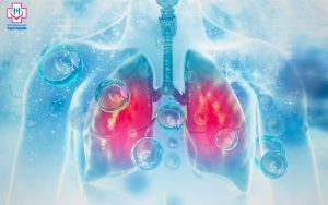 ung thư phổi giai đoạn đầu chẩn đoán và điều trị