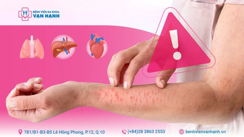 lupus ban đỏ hệ thống