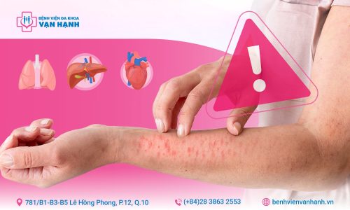 lupus ban đỏ hệ thống