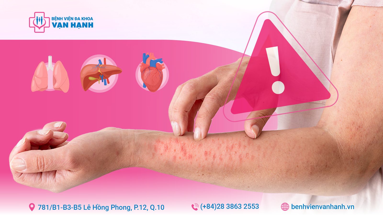 lupus ban đỏ hệ thống