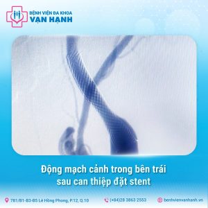 tầm soát đột quỵ