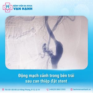 tầm soát đột quỵ