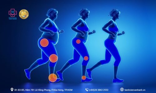béo phì, gây thoái hoá khớp