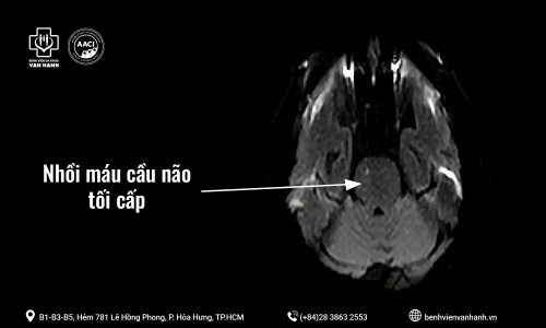 251209 Ca đột quỵ Tiêu sợi huyết giờ 3,5_Cover Zalo va Website_1600x900 2