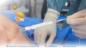 Đứt dây chằng chéo lần thứ 2, đa tổn thương khớp gối