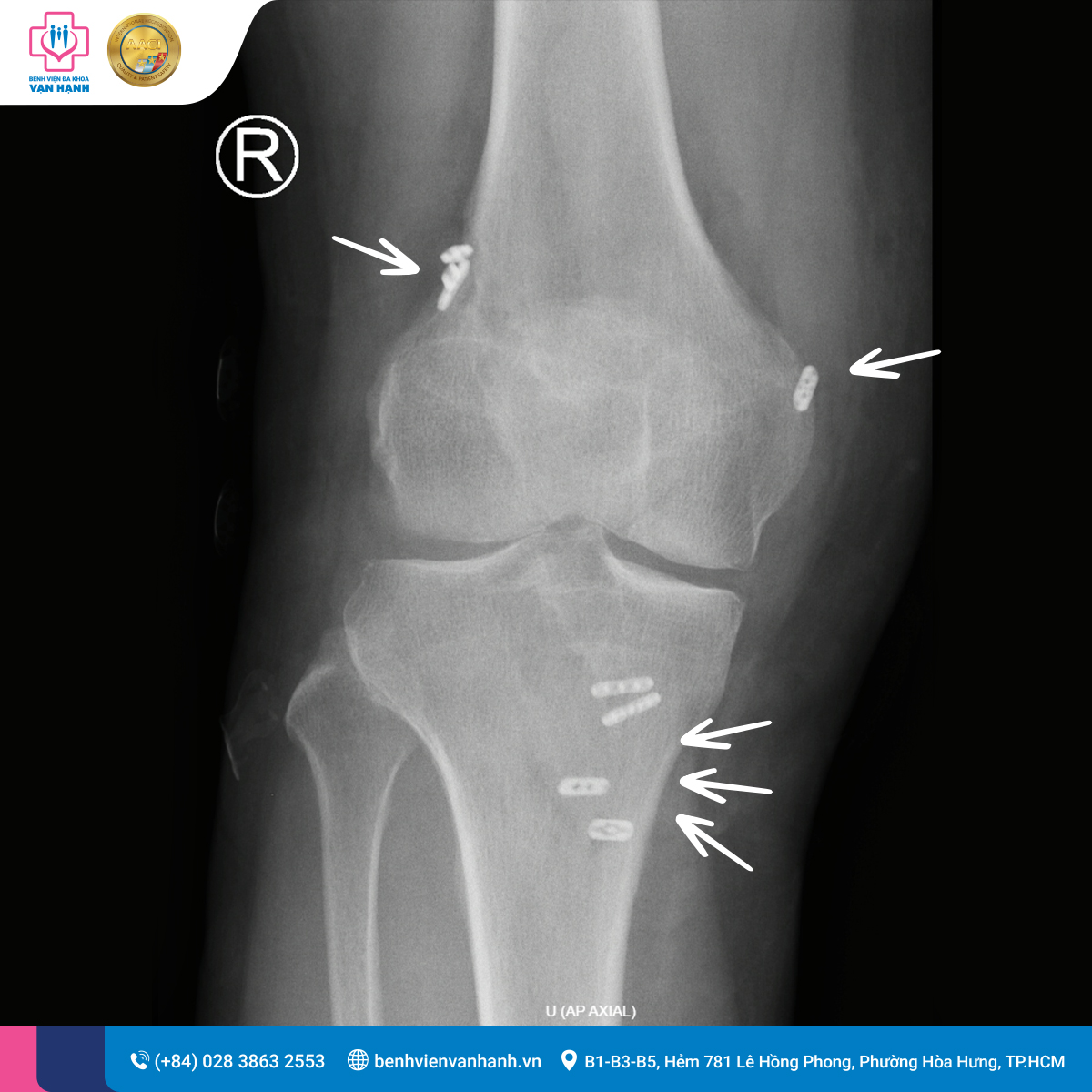 Dây chằng chéo nhân tạo được cố định