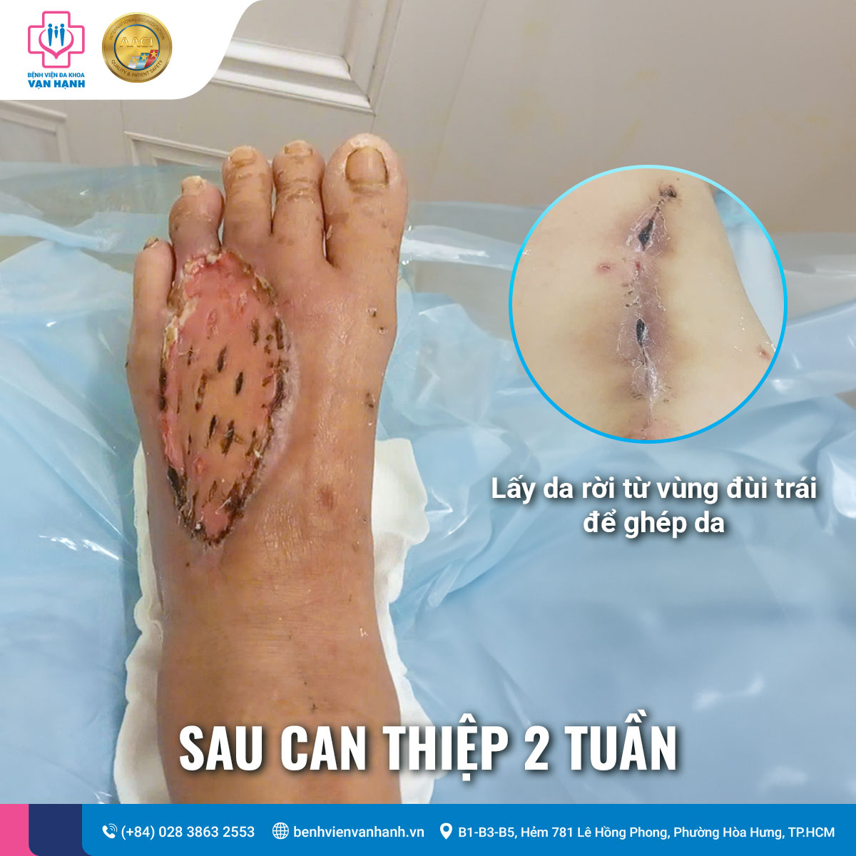 Tình trạng của bàn chân sau can thiệp