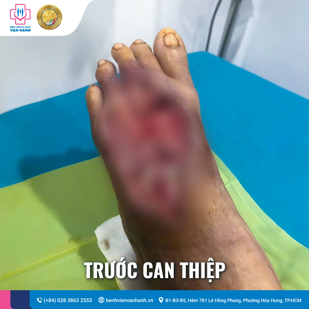 Tình trạng hoại tử bàn chân trước khi can thiệp
