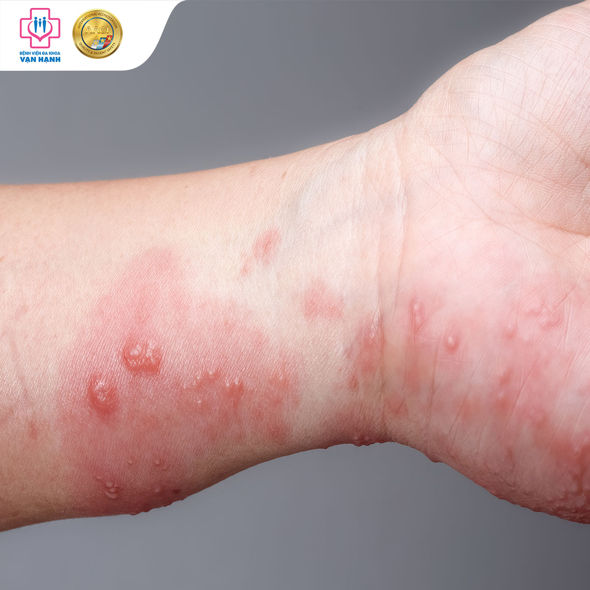 Dấu hiệu viêm não mô cầu gây nổi ban