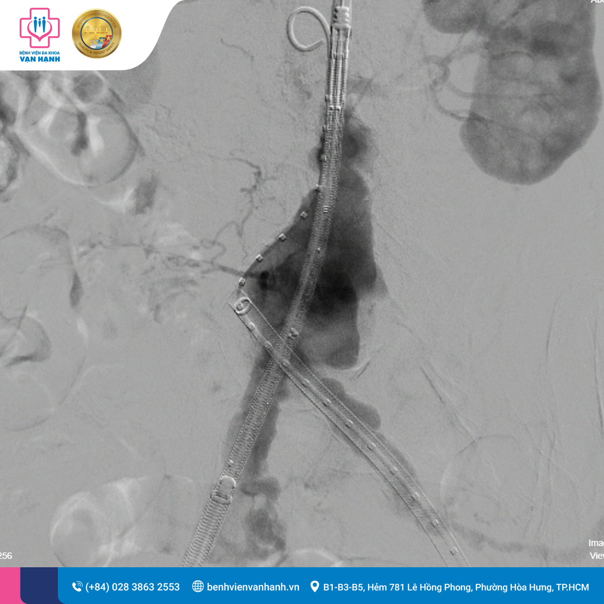 Stent được đặt vào giúp động mạch trở về trạng thái bình thường