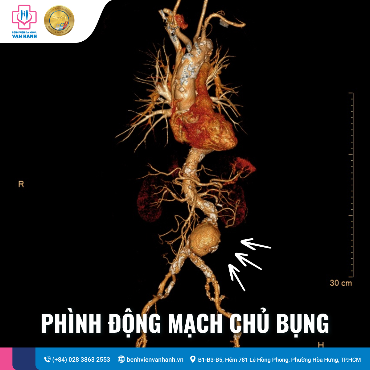 phình động mạch chủ bụng