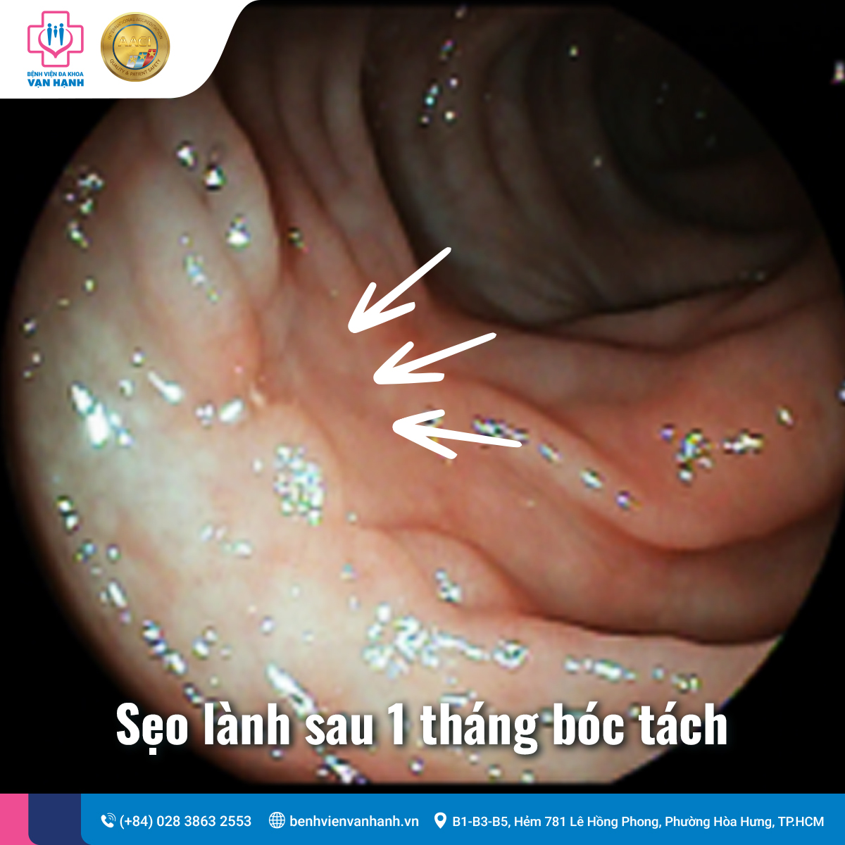 Sẹo lành sau khi cắt đốt polyp lớn