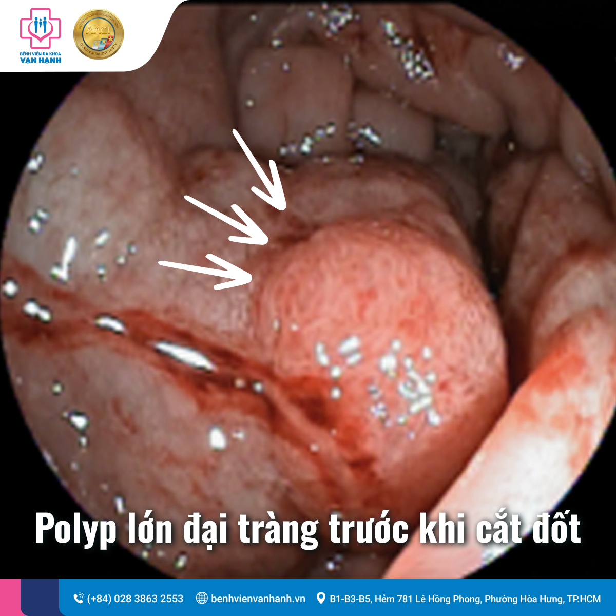 Polyp đại tràng lớn trước đại phẫu