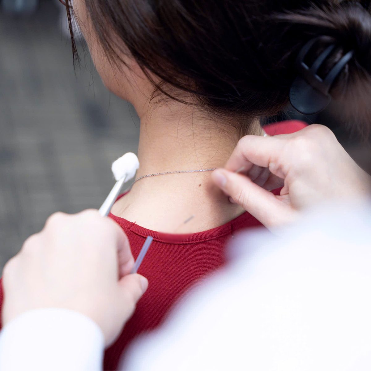 Sử dụng phương pháp châm cứu trong điều trị chấn thương