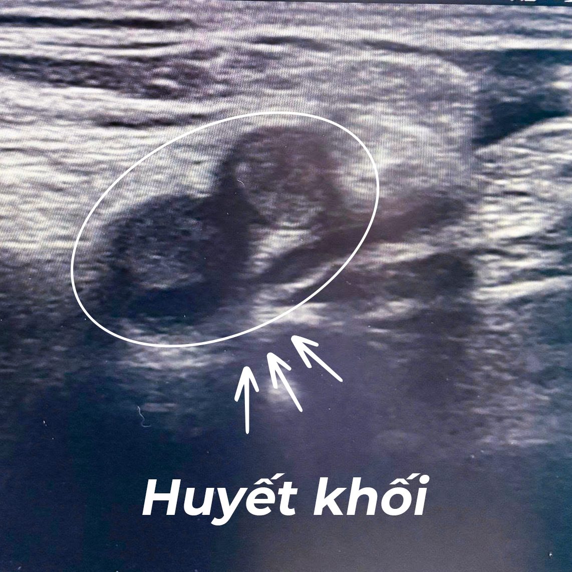CAN THIỆP CẤP CỨU TẮC ĐỘNG MẠCH CHI DƯỚI TRÊN BỆNH NHÂN SUY TIM NẶNG VÀ RUNG NHĨ