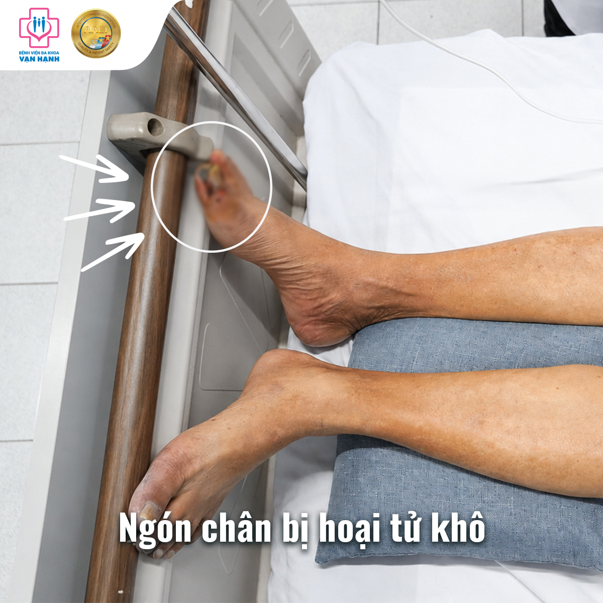 Ngón chân phải bị hoại tử khô Ngón chân phải bị hoại tử khô