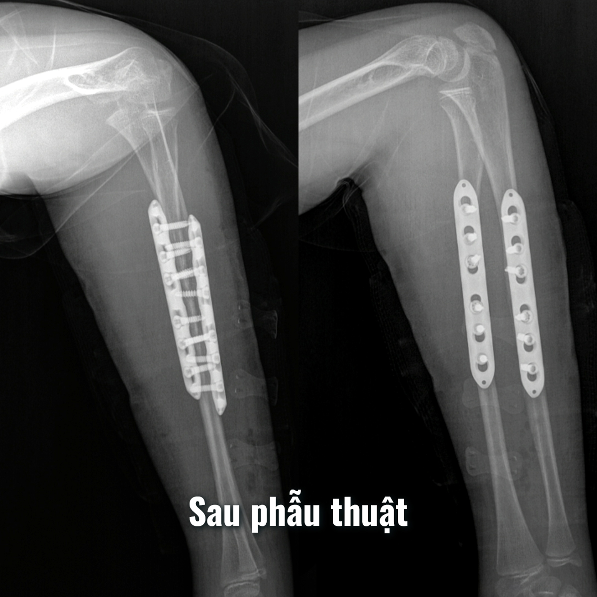Phẫu thuật cấp cứu thành công ca gãy gập hai xương cẳng tay ở bệnh nhi 13 tuổi
