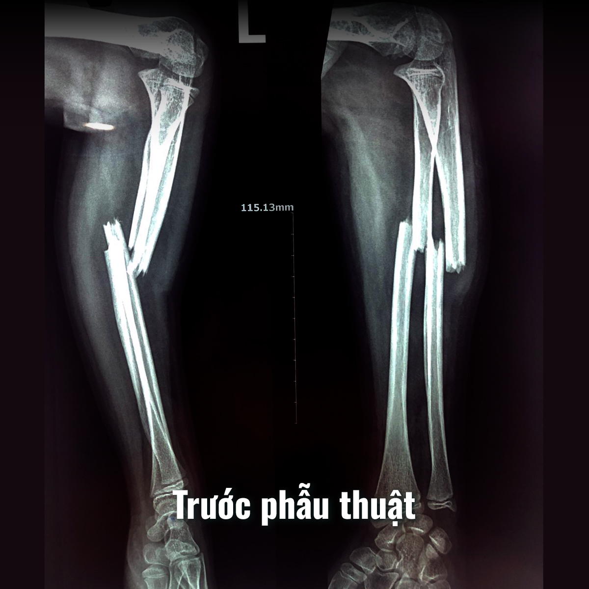 Phẫu thuật cấp cứu thành công ca gãy gập hai xương cẳng tay ở bệnh nhi 13 tuổi