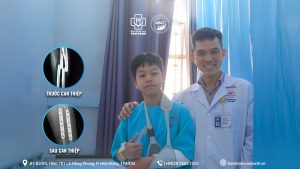 Phẫu thuật cấp cứu thành công ca gãy gập hai xương cẳng tay ở bệnh nhi 13 tuổi