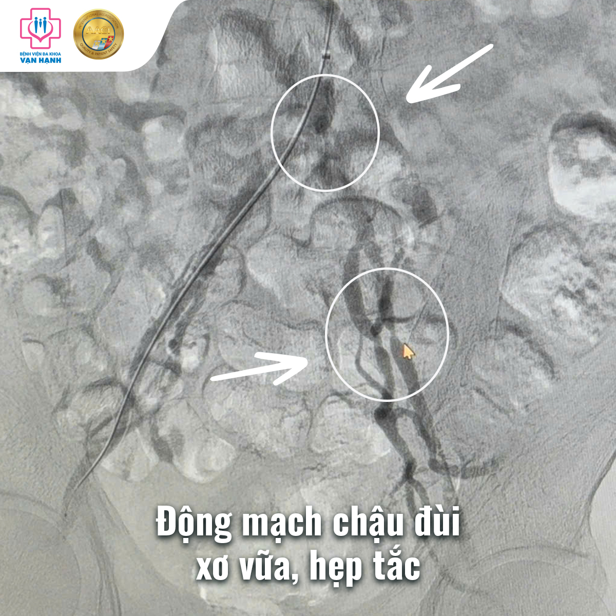 Động mạch chậu đùi xơ vữa gây hẹp tắc Động mạch chậu đùi xơ vữa gây hẹp tắc