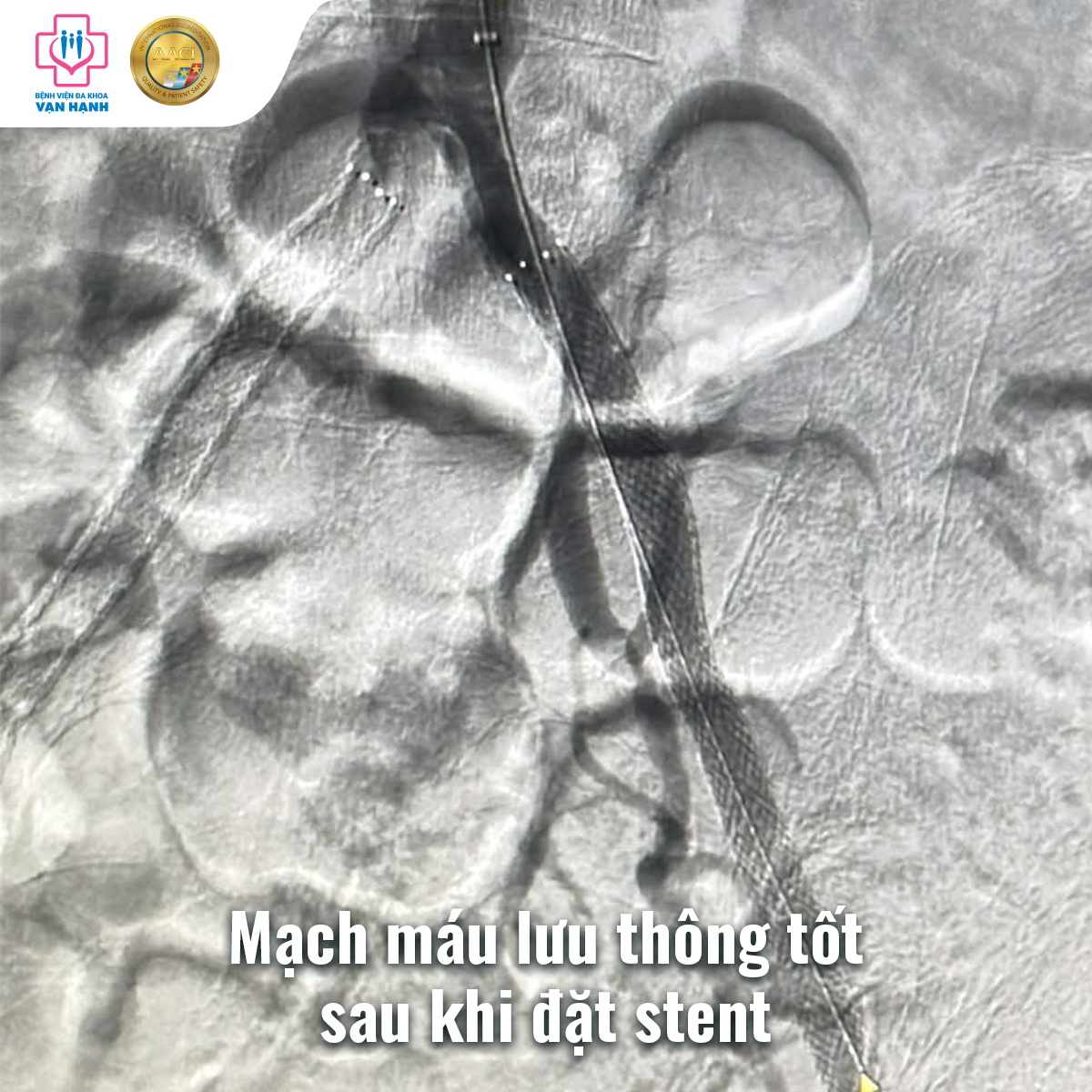 Hình ảnh mạch máu lưu thông tốt sau khi đặt stent Hình ảnh mạch máu lưu thông tốt sau khi đặt stent