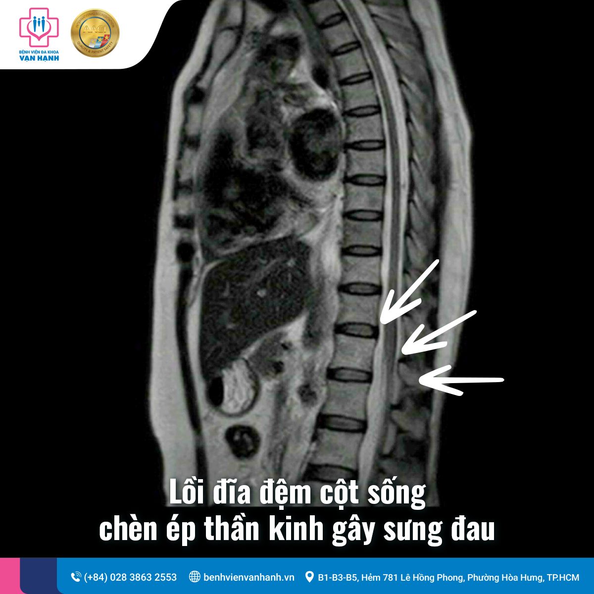 Lồi đĩa đệm gây đau lưng & cổ vai gáy trầm trọng: Bệnh nhân Việt Kiều kiên trì về nước Cấy Chỉ phục hồi