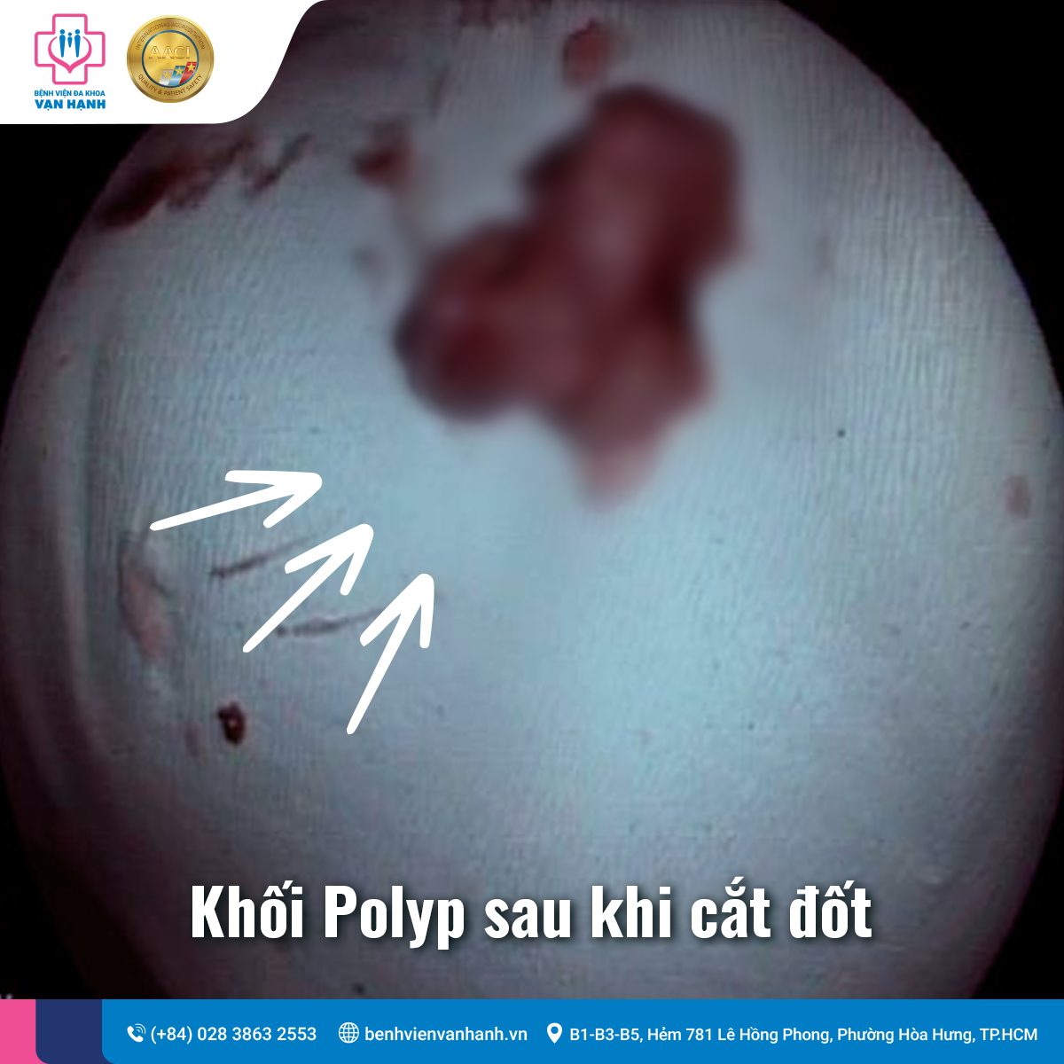 Phát hiện sớm ung thư đại trực tràng nguyên phát lần 2 nhờ thói quen tầm soát định kỳ