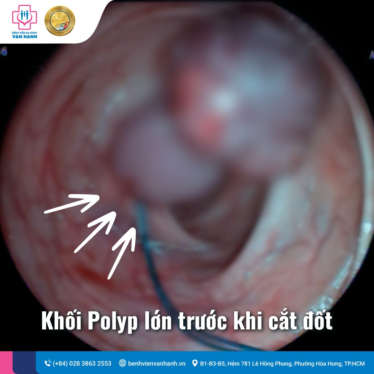 Phát hiện sớm ung thư đại trực tràng nguyên phát lần 2 nhờ thói quen tầm soát định kỳ