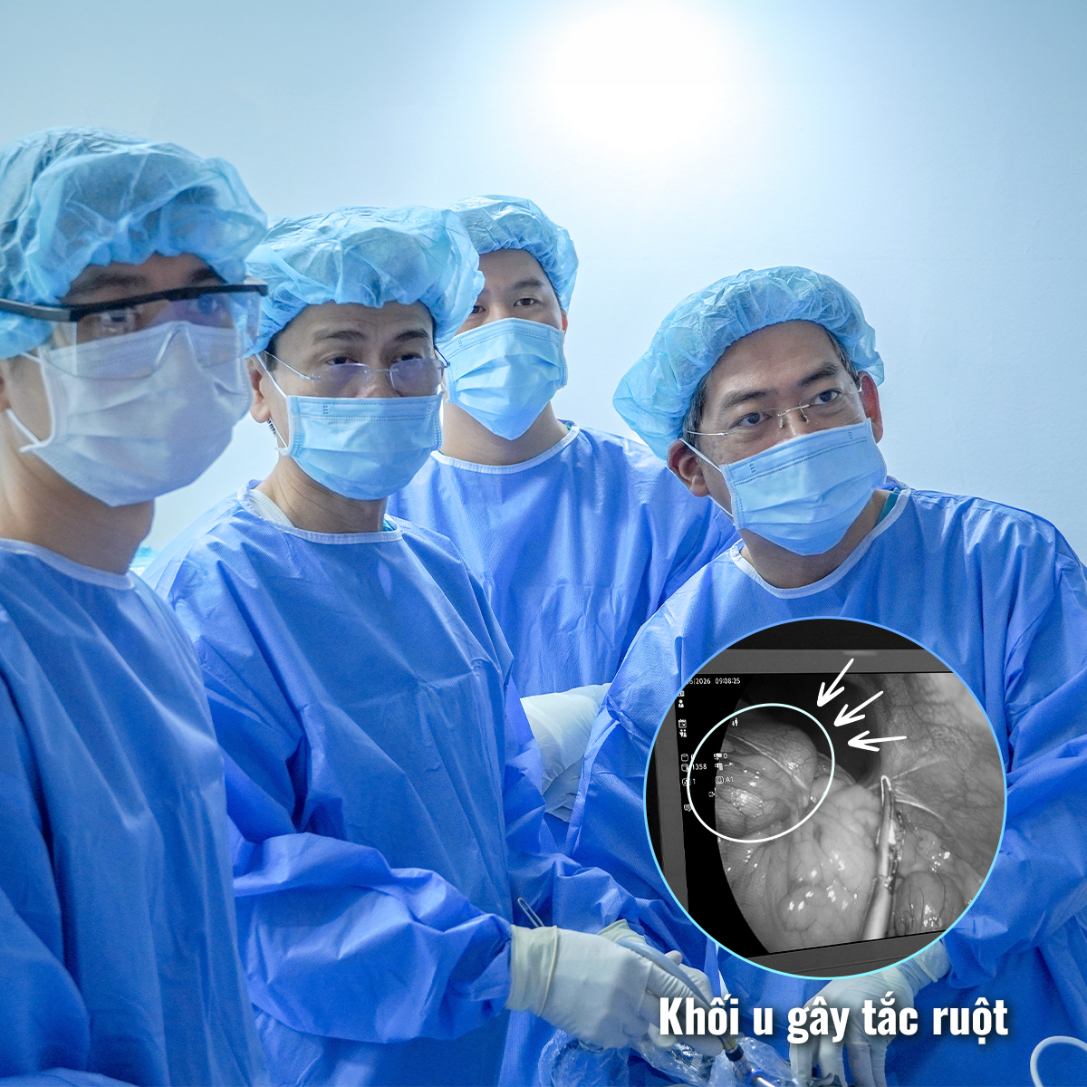 Ekip tiến hành phẫu thuật nội soi phát hiện khối u gây tắc ruột của bệnh nhân Ekip tiến hành phẫu thuật nội soi phát hiện khối u gây tắc ruột của bệnh nhân