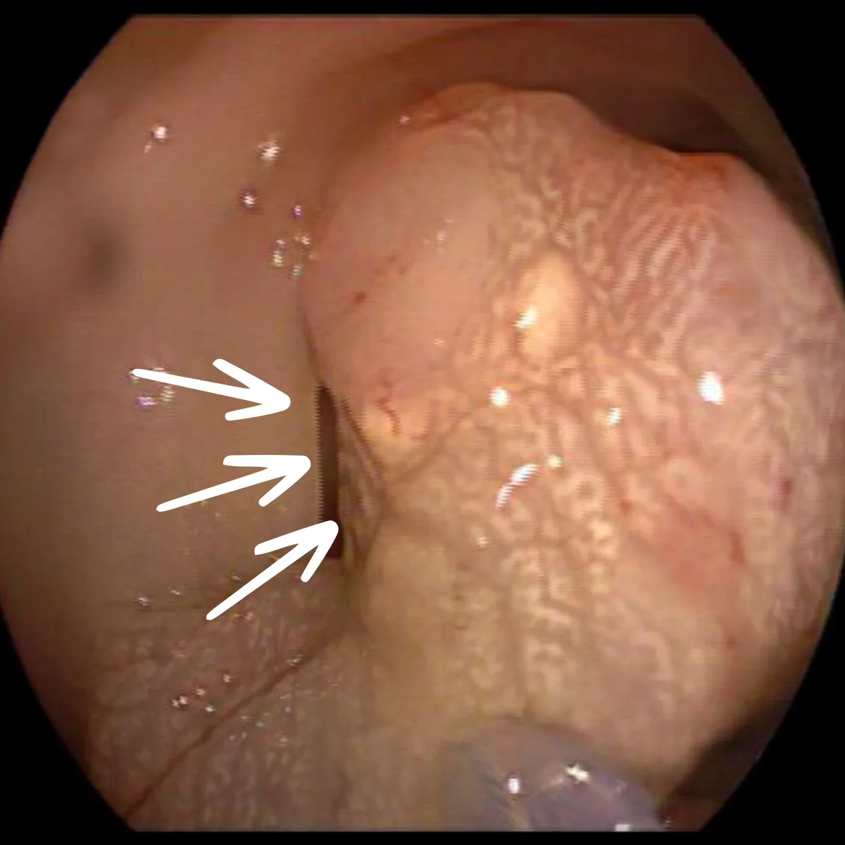 Khối polyp lớn có kích thước khoảng 22mm phát hiện qua nội soi