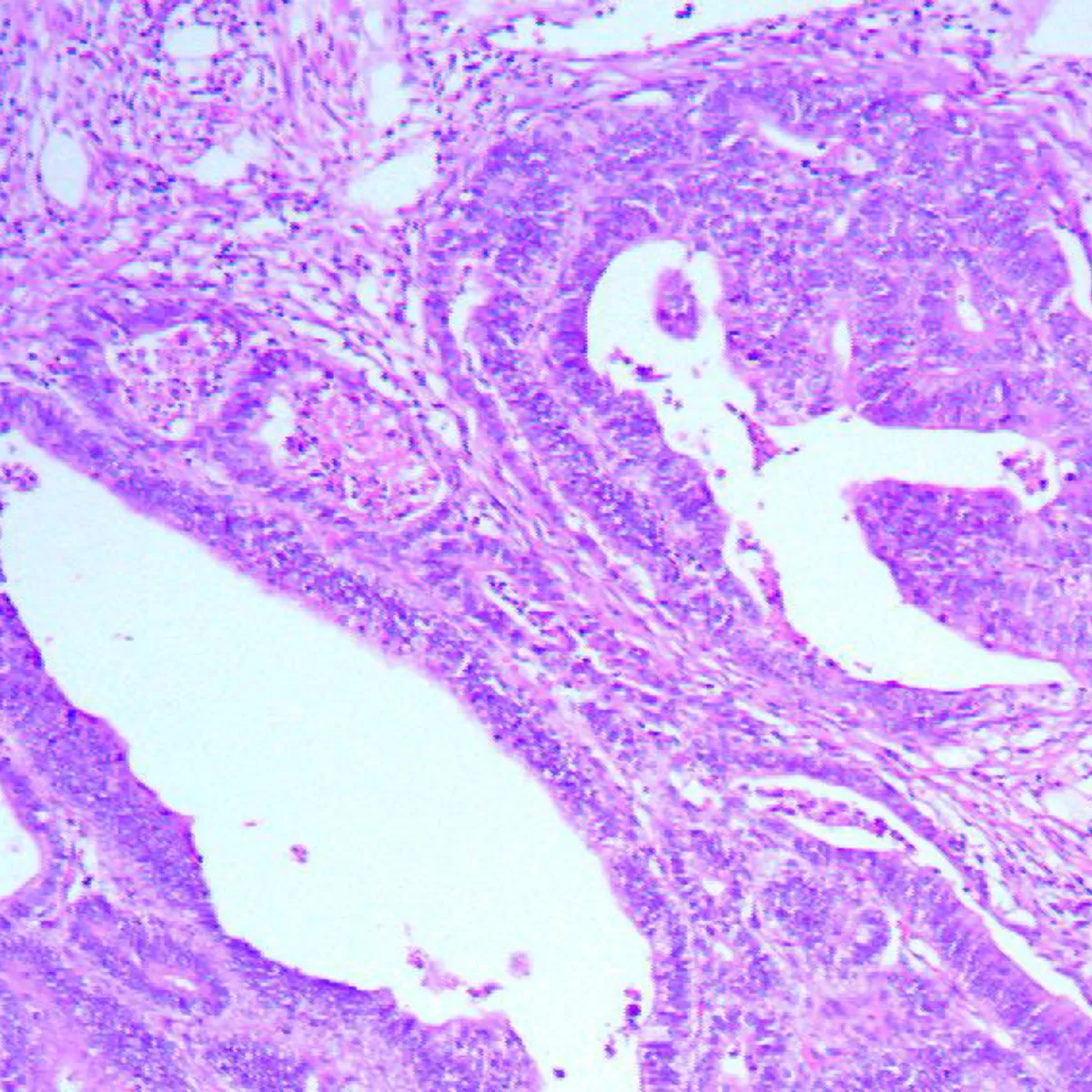 Hình ảnh vi thể ghi nhận của khối polyp